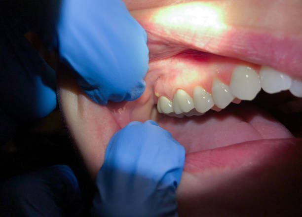 Best Cracked Tooth Emergency Dentist  in Patterson, CA
