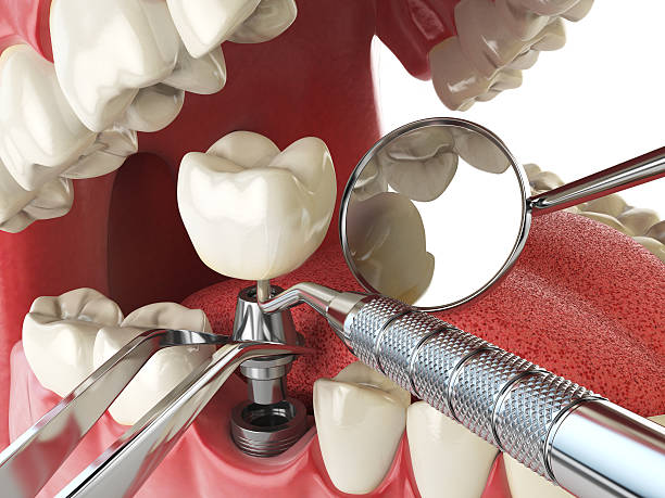 Best Dentist for Tooth Abscess  in Patterson, CA